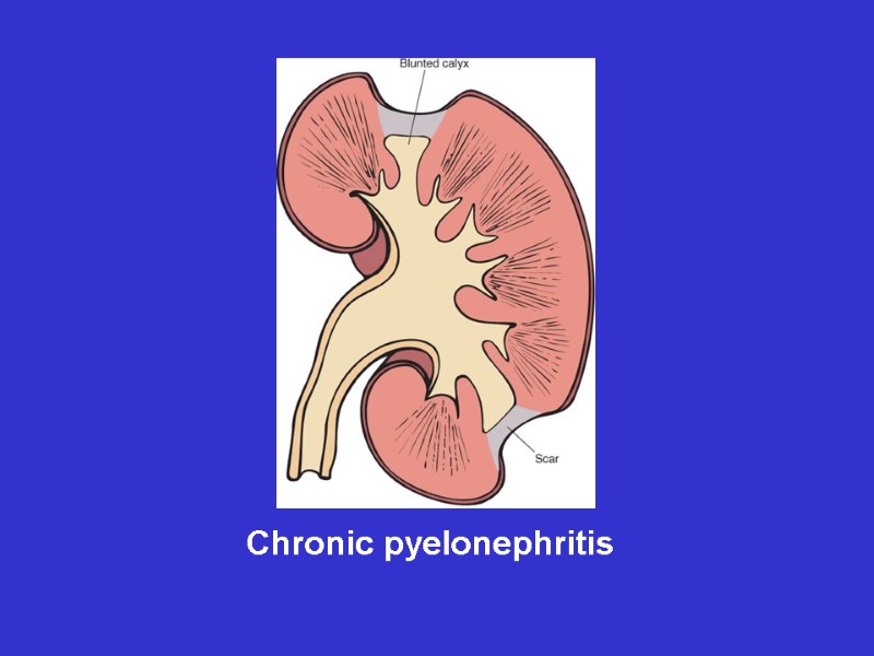 Chronic pyelonephritis